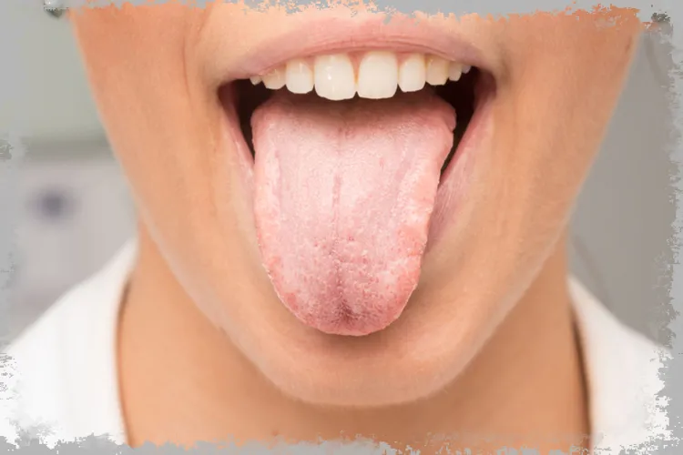 Біле покриття (осад) на язиці - це означає у дитини, як позбутися