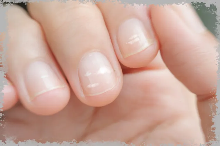 Белые пятна на ногтях, обесцвечивание (лейконихия): причины, лечение